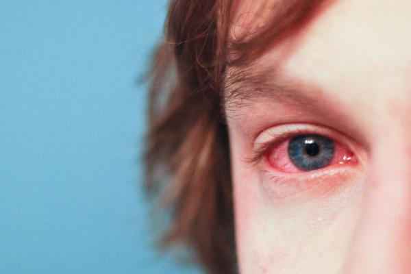 redeyes