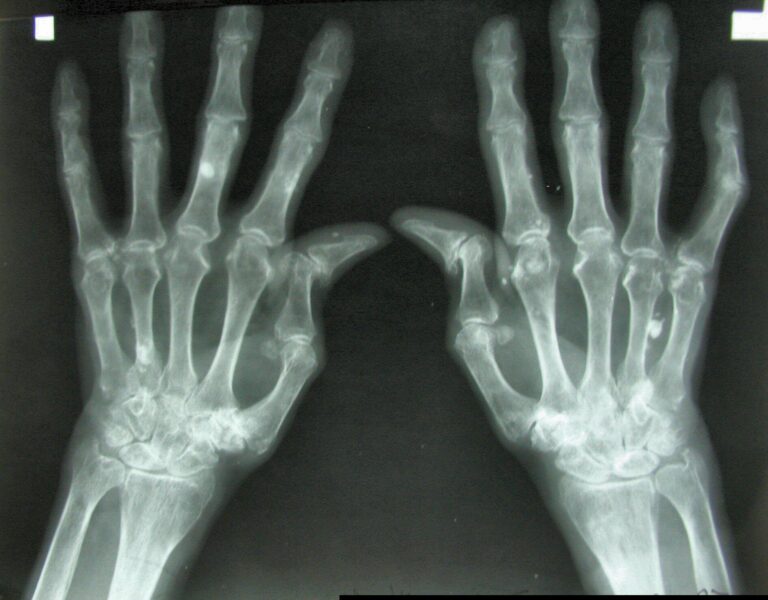 Arthritis hands1 768x600